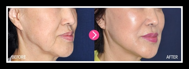 高位筋膜懸吊中下臉拉皮 高位筋膜懸吊中下臉拉皮