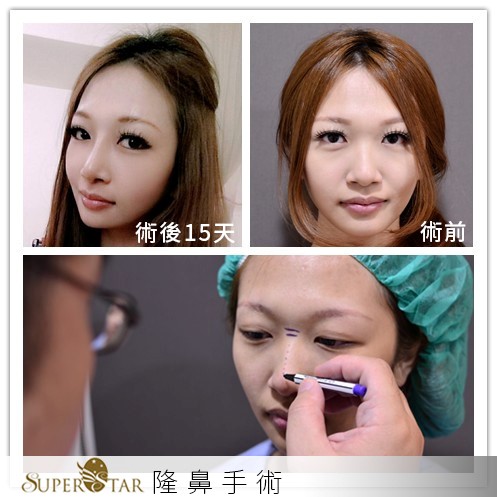 人工骨韓式隆鼻 人工骨韓式隆鼻