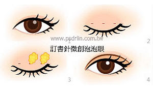 訂書針微創泡泡眼 訂書針微創泡泡眼