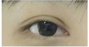 縫雙眼皮+開眼頭 => 平行大外雙(開放式雙眼皮) 縫雙眼皮+開眼頭 => 平行大外雙(開放式雙眼皮)