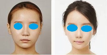 人工骨韓式隆鼻 案例 人工骨韓式隆鼻 案例