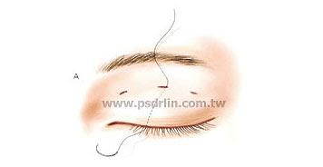 訂書針縫雙眼皮 訂書針縫雙眼皮