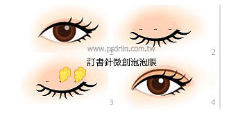 訂書針微創泡泡眼手術 訂書針微創泡泡眼手術