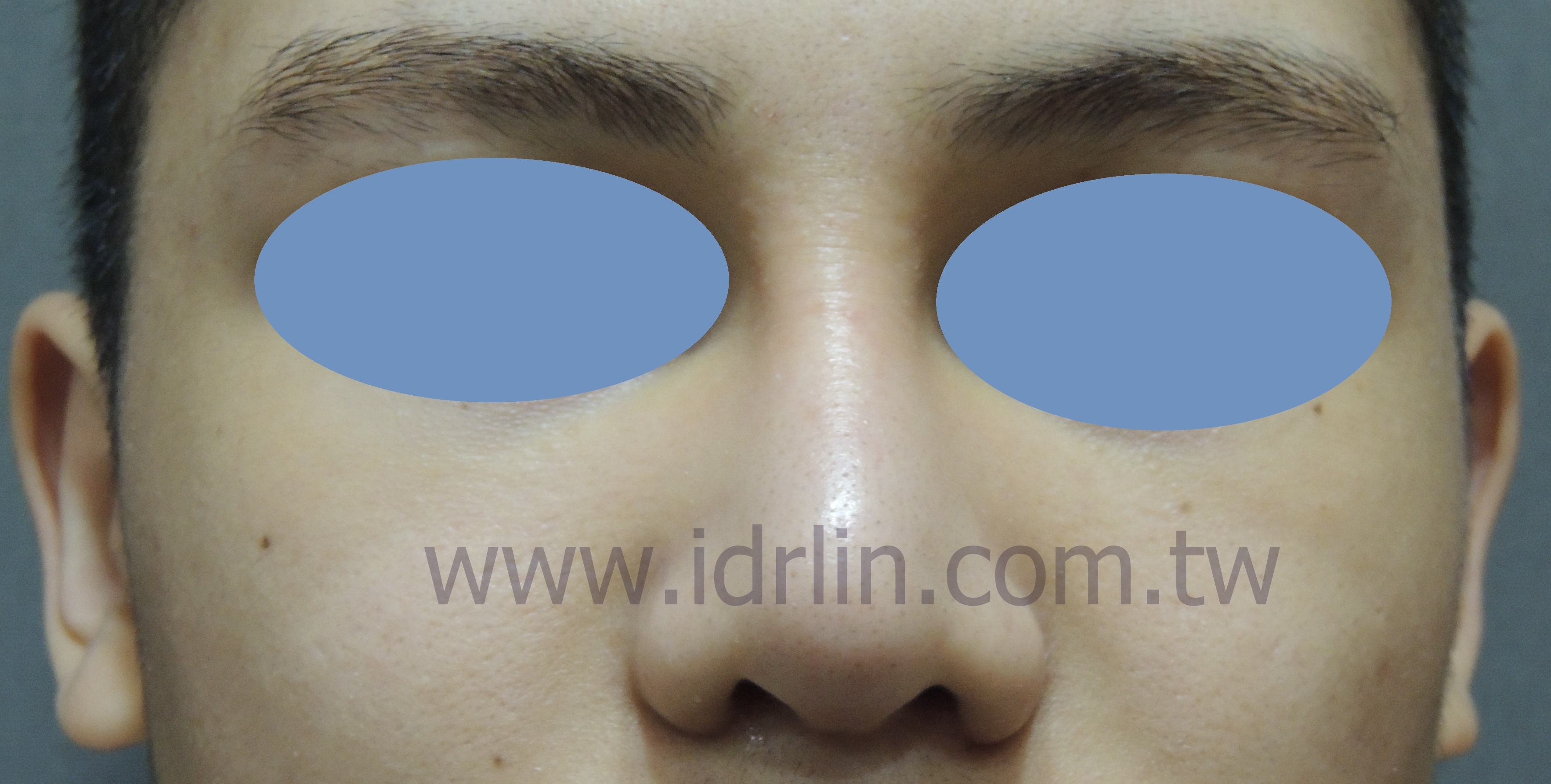 全自體肋骨隆鼻 全自體肋骨隆鼻