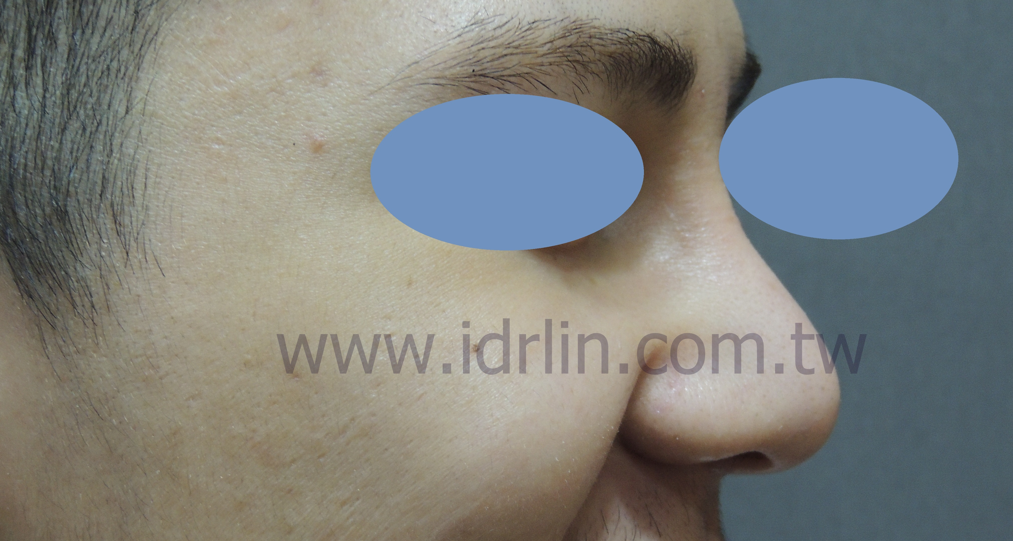 全自體肋骨隆鼻 全自體肋骨隆鼻