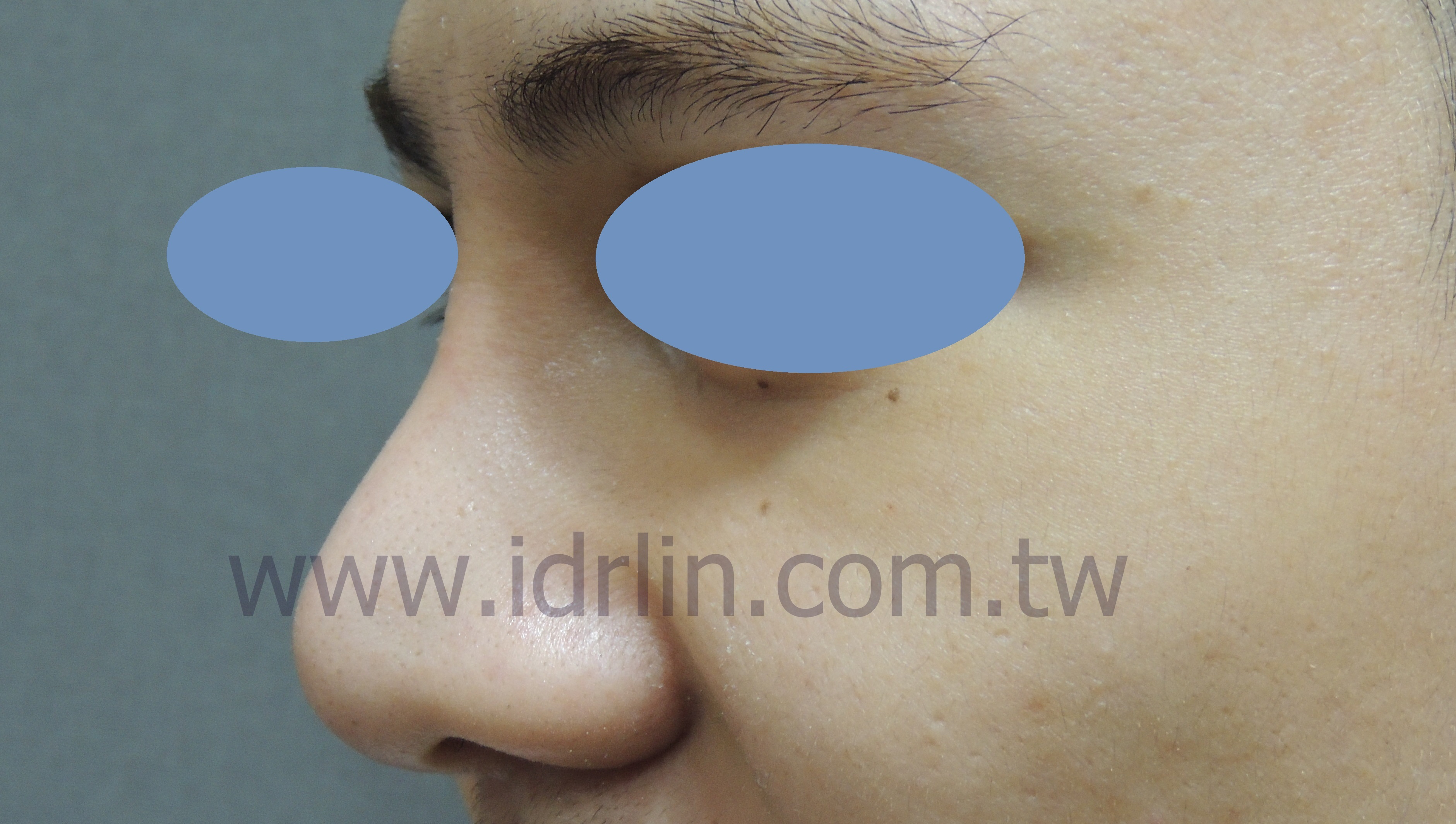 全自體肋骨隆鼻 全自體肋骨隆鼻