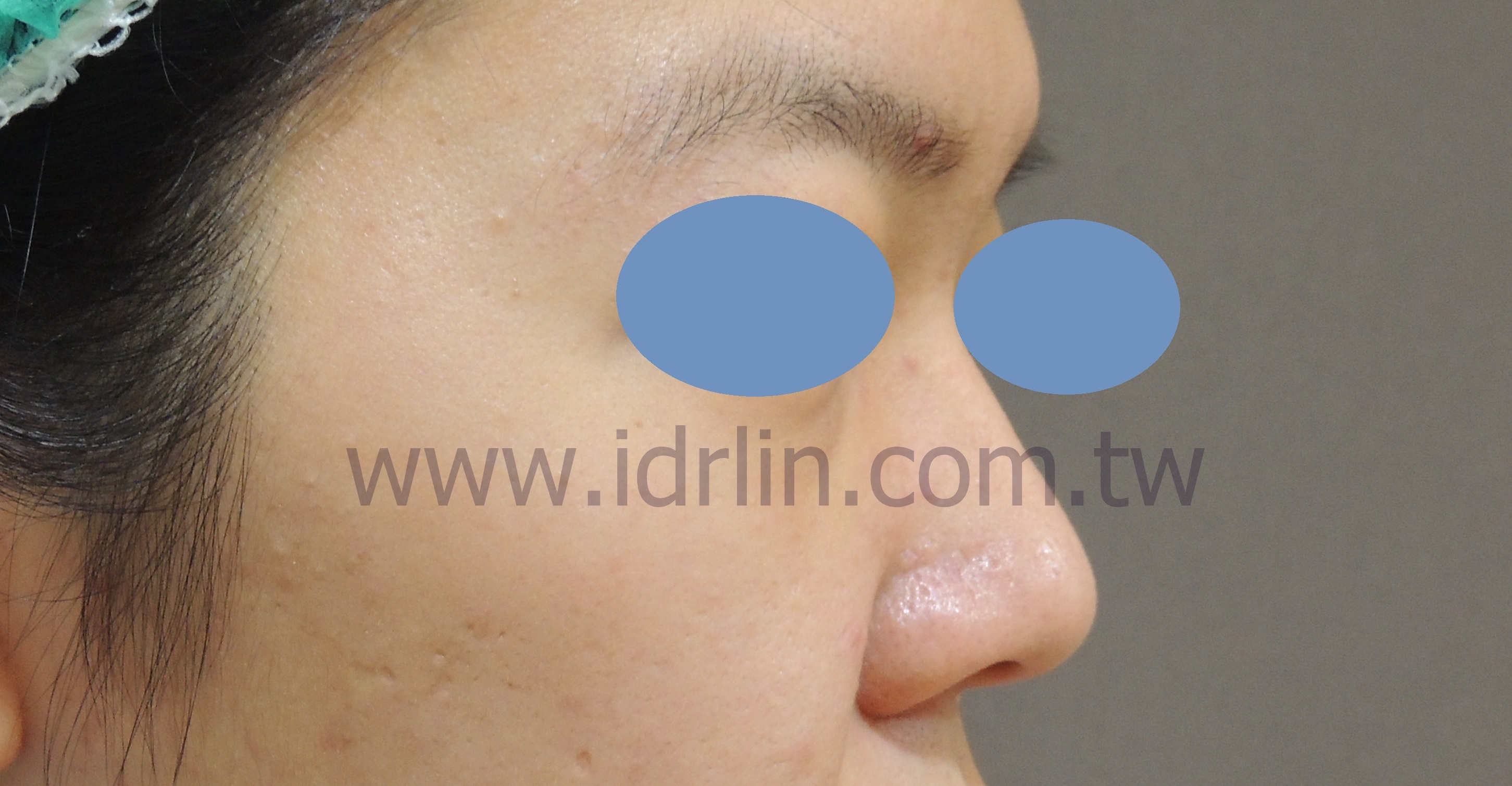 全自體肋骨韓式隆鼻