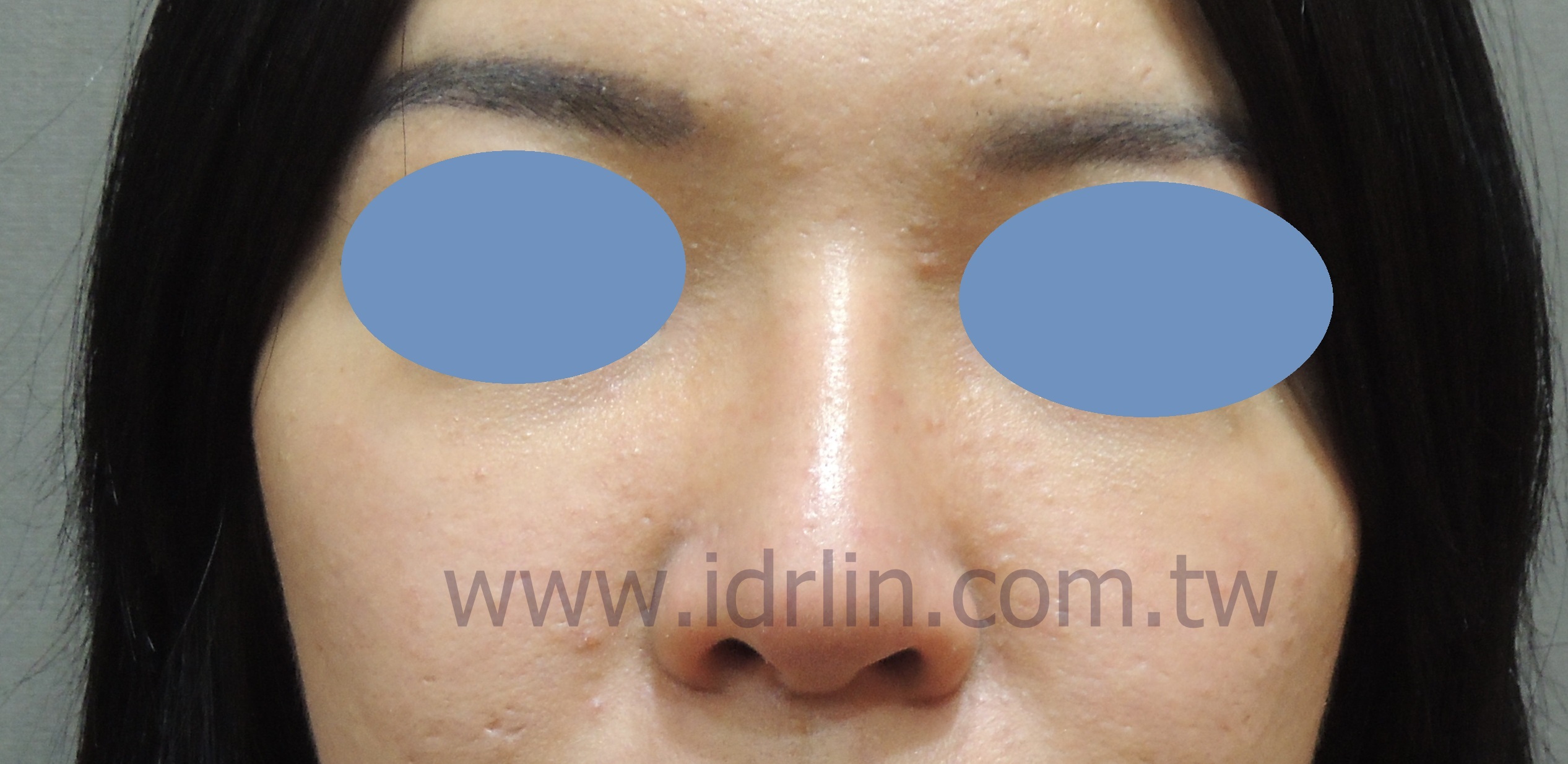 全自體肋骨韓式隆鼻 全自體肋骨韓式隆鼻