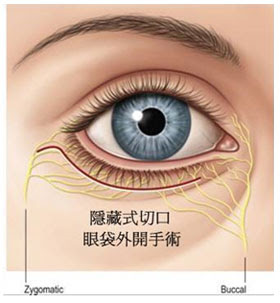 眼袋外開補淚溝 眼袋外開補淚溝