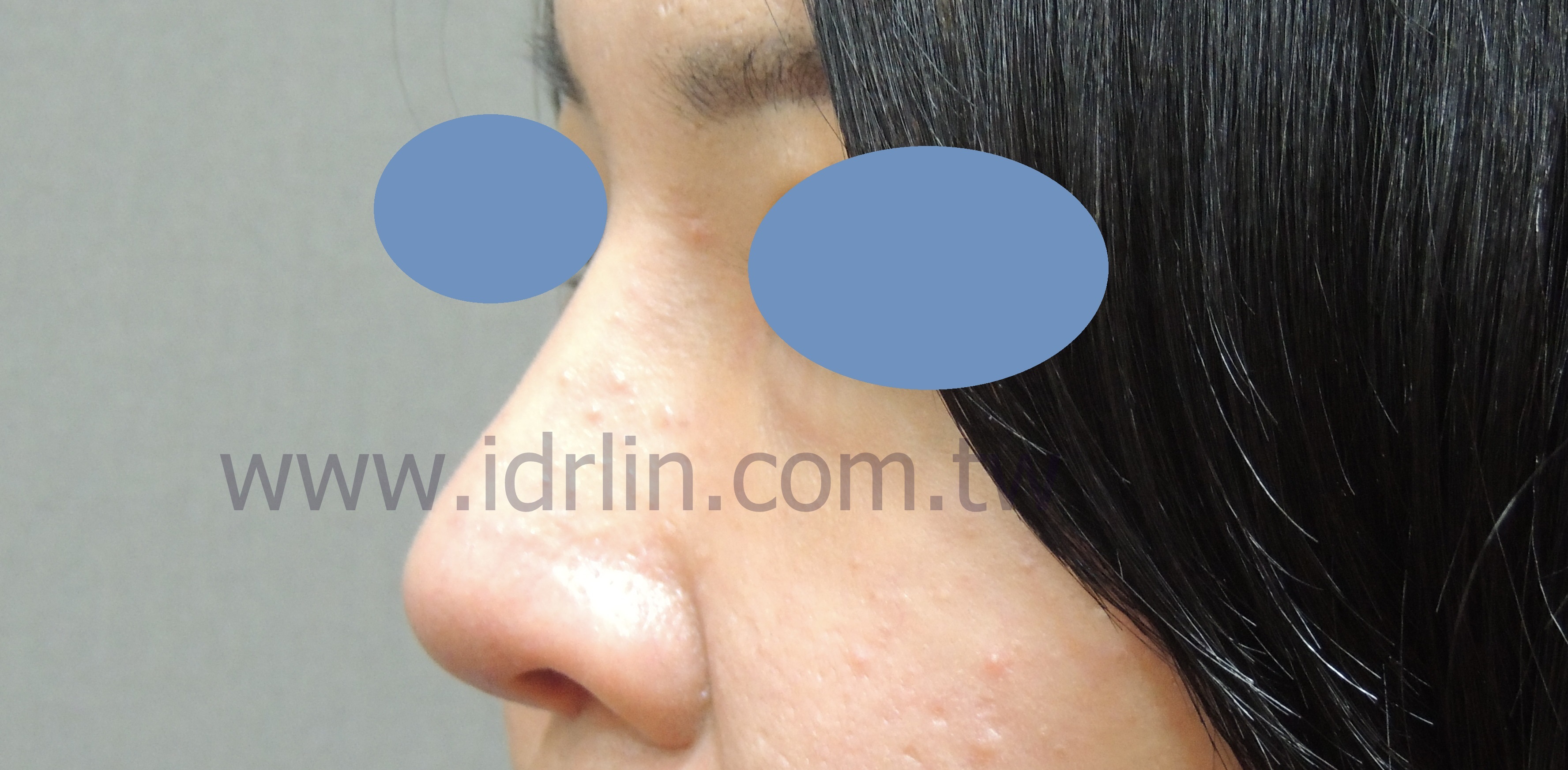 全自體肋骨韓式隆鼻 全自體肋骨韓式隆鼻