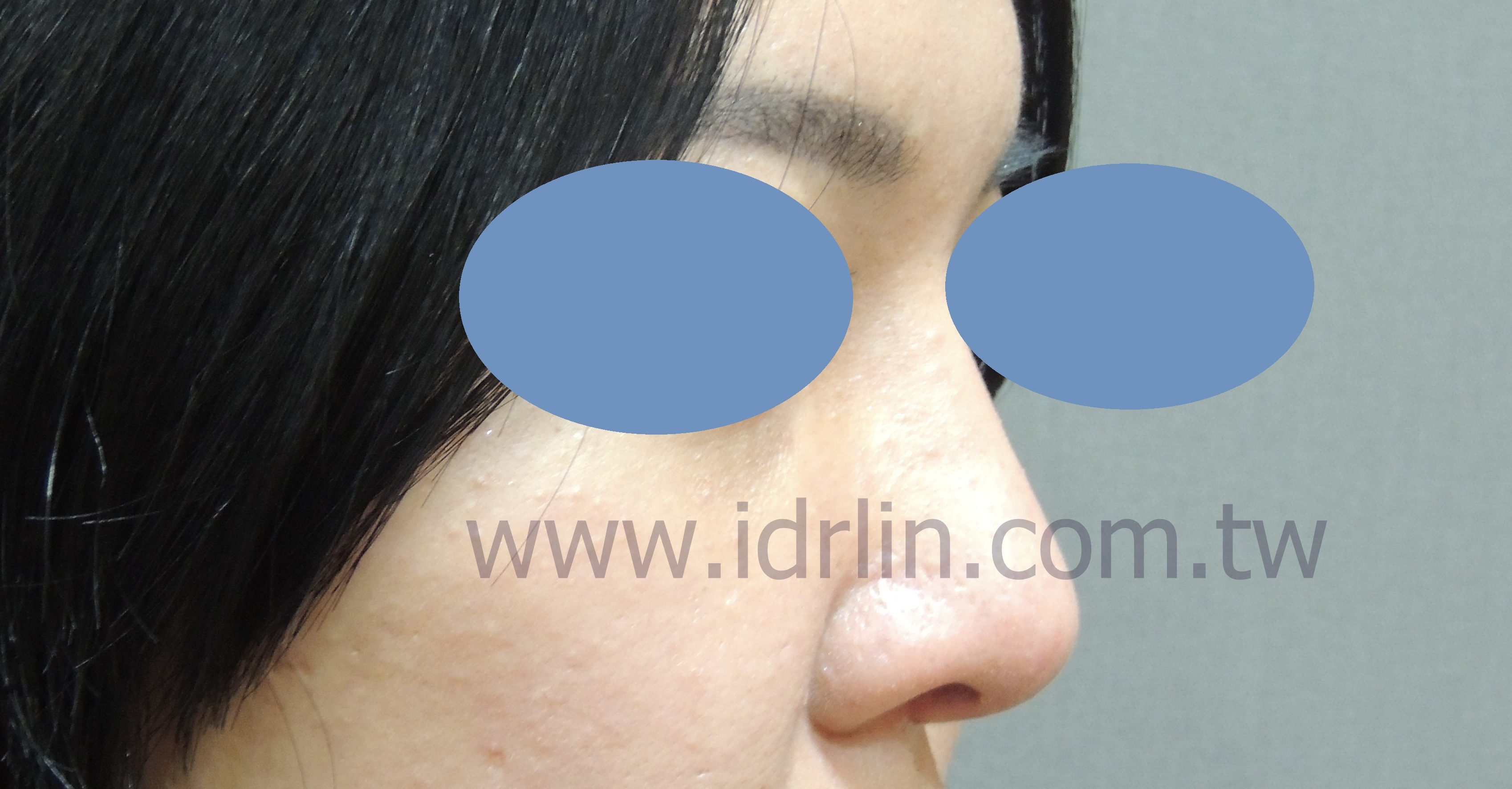 全自體肋骨韓式隆鼻 全自體肋骨韓式隆鼻