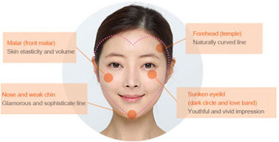 自體脂肪適合填補區域 自體脂肪適合填補區域