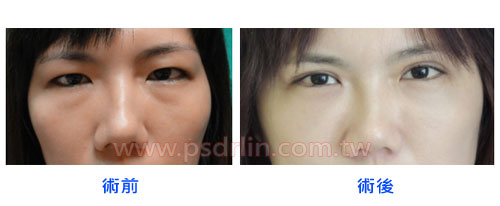 無痕眼袋內開補淚溝+自體脂肪豐蘋果肌 無痕眼袋內開補淚溝+自體脂肪豐蘋果肌