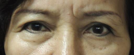 老化性割雙眼皮 老化性割雙眼皮