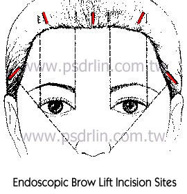 前額拉皮 前額拉皮