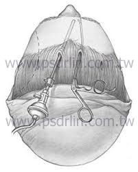 內視鏡拉皮 內視鏡拉皮