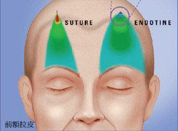 內視鏡五爪釘前額拉皮 內視鏡五爪釘前額拉皮