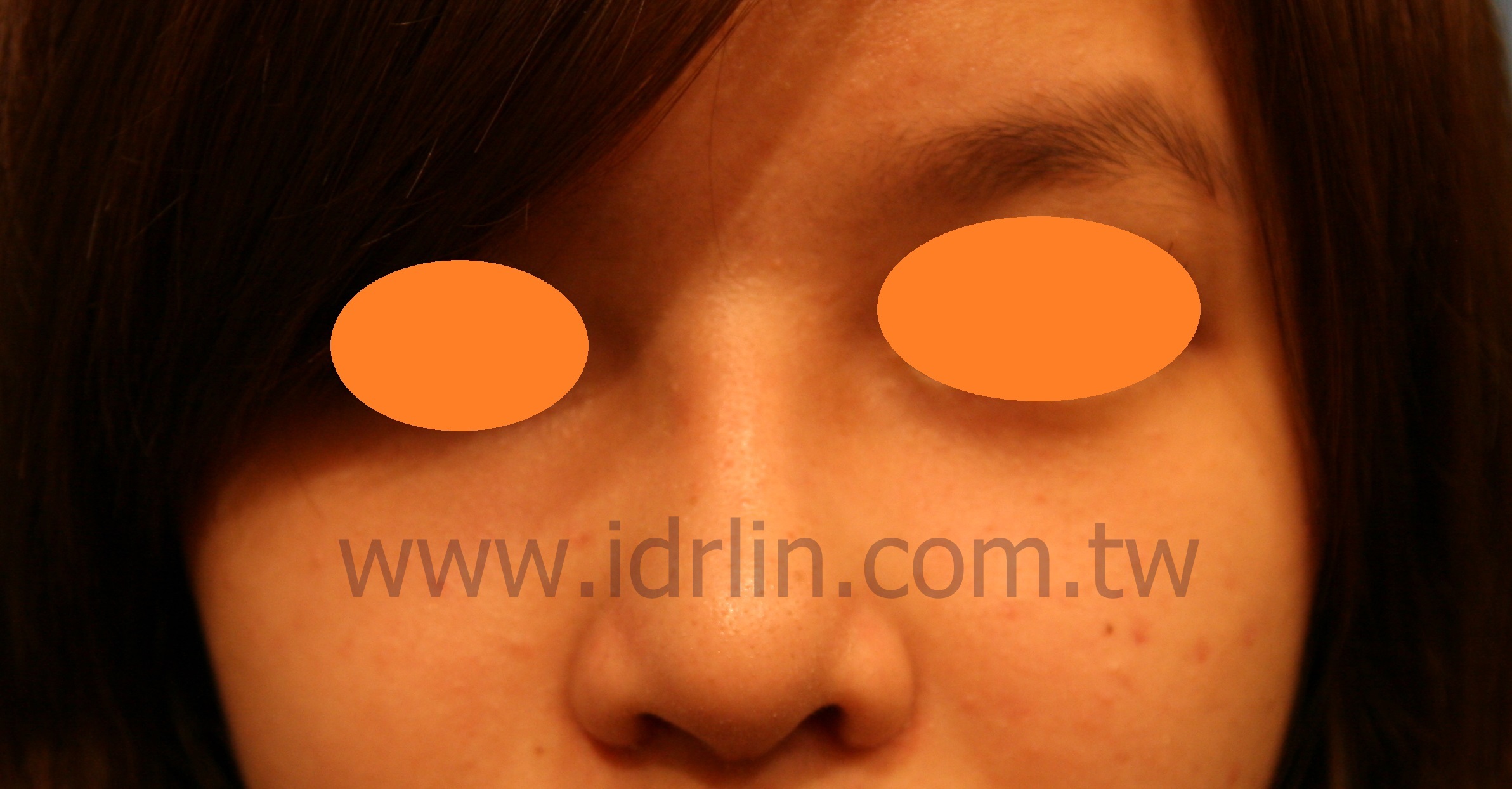 韓式隆鼻術後 韓式隆鼻術後