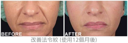 洢蓮絲, Ellanse, 依戀詩功效 洢蓮絲, Ellanse, 依戀詩功效