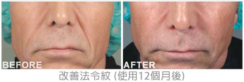 洢蓮絲, Ellanse, 依戀詩 案例 洢蓮絲, Ellanse, 依戀詩 案例