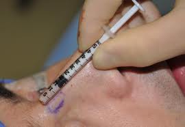 隆鼻局部麻醉 隆鼻局部麻醉