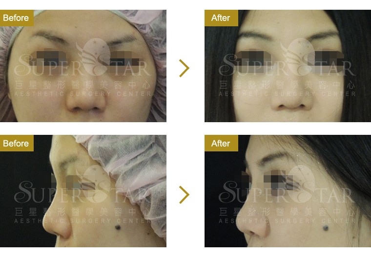 人工骨韓式隆鼻 人工骨韓式隆鼻