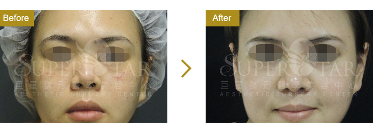 三段式隆鼻-進階版韓式隆鼻 三段式隆鼻-進階版韓式隆鼻