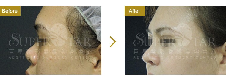 三段式隆鼻-進階版韓式隆鼻 三段式隆鼻-進階版韓式隆鼻