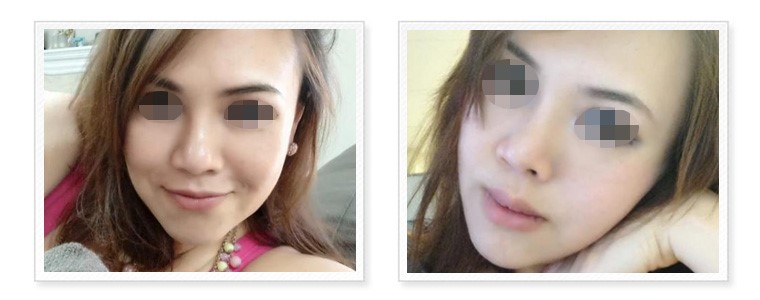 三段式隆鼻-進階版韓式隆鼻 三段式隆鼻-進階版韓式隆鼻