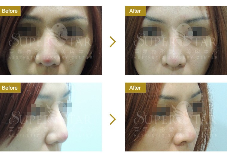 二次鼻整形 - 隆鼻重修 二次鼻整形 - 隆鼻重修