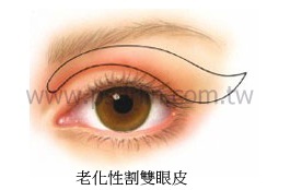 老化性割雙眼皮 老化性割雙眼皮