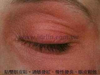 貼雙眼皮貼的壞處 貼雙眼皮貼的壞處