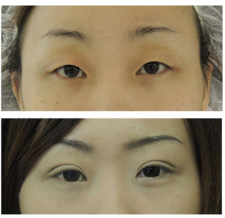 2+1訂書針縫雙眼皮 2+1訂書針縫雙眼皮