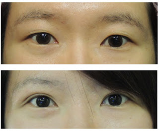 2+1訂書針縫雙眼皮 2+1訂書針縫雙眼皮