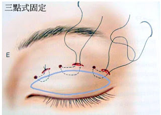 訂書針縫雙眼皮 訂書針縫雙眼皮