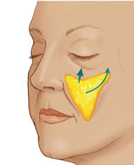 拉皮手術 拉皮手術