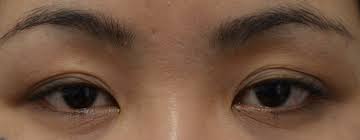 雙眼無神, 雙眼皮折痕不深, 眼皮太多折痕, 細紋 雙眼無神, 雙眼皮折痕不深, 眼皮太多折痕, 細紋