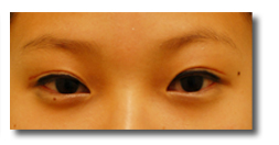 雙眼皮不夠深邃, 眼頭沒有開 雙眼皮不夠深邃, 眼頭沒有開