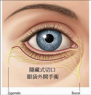 眼袋外開手術 眼袋外開手術