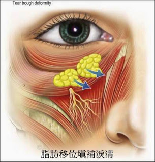 眼袋外開補淚溝 眼袋外開補淚溝