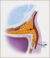 無痕眼袋內開補淚溝 無痕眼袋內開補淚溝