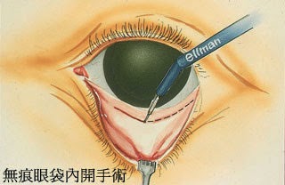 眼袋內開手術 眼袋內開手術