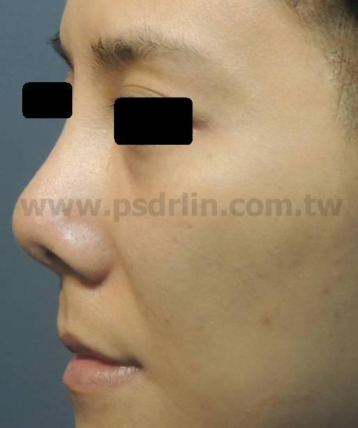 失敗的鼻子 失敗的鼻子