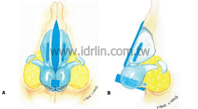 韓式隆鼻 韓式隆鼻