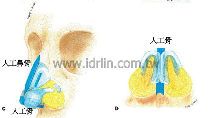 人工骨韓式隆鼻 人工骨韓式隆鼻
