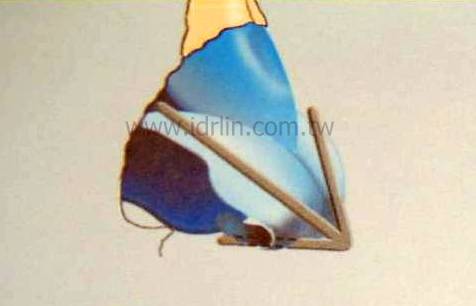 韓式隆鼻 - 鼻頭雕塑 韓式隆鼻 - 鼻頭雕塑