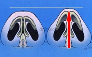 縮鼻翼是要讓鼻子仰角呈現的鈍角三角形變成正三角形 縮鼻翼是要讓鼻子仰角呈現的鈍角三角形變成正三角形