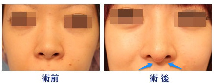 韓式隆鼻後海鷗線過長 韓式隆鼻後海鷗線過長