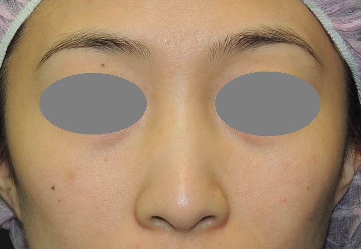 塌鼻(Flat nose, Snub nose) 塌鼻(Flat nose, Snub nose)