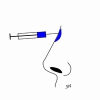 玻尿酸隆鼻 玻尿酸隆鼻